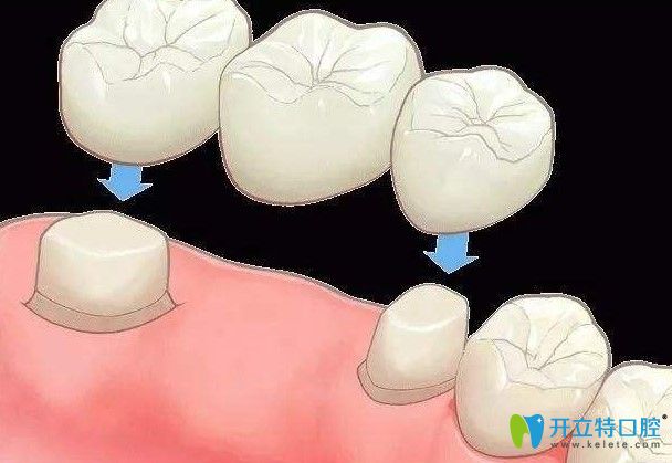 修大夫口腔蘇明坤醫(yī)生解析：固定義齒修復有哪些優(yōu)缺點