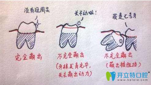 林智偉醫(yī)生講解智齒一般分類