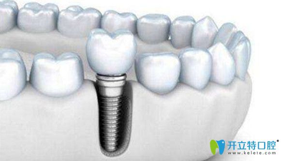種牙后要定期檢查復(fù)診 種牙后要定期檢查復(fù)診