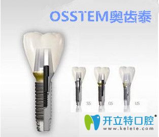 中諾口腔奧齒泰種植體
