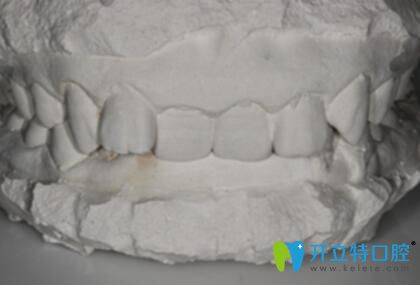 蘭州妹子28歲時戴金屬自鎖托槽牙套矯正了多年的深覆合牙齒