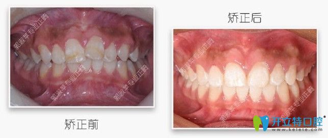 正面圖，牙齒不僅深覆蓋而且還不齊