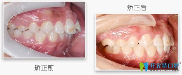對比下矯正前后的照片，效果還是不錯吧