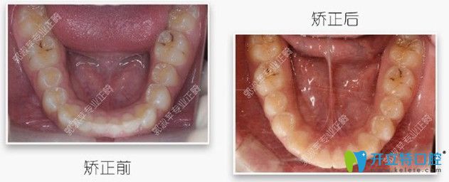 磨牙后推兩年后的照片