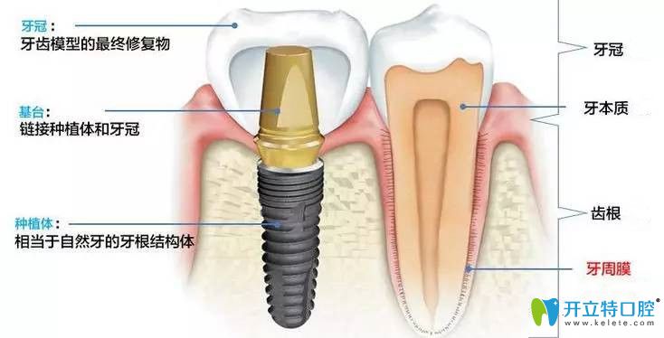 種植牙構(gòu)造分布圖