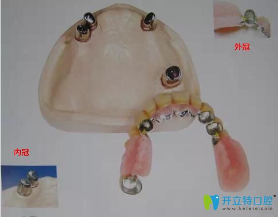 套筒冠式覆蓋義齒