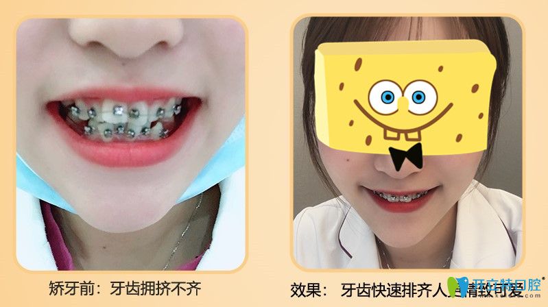 牙齒擁擠不齊的小姐姐在廣大口腔做完矯正后的效果