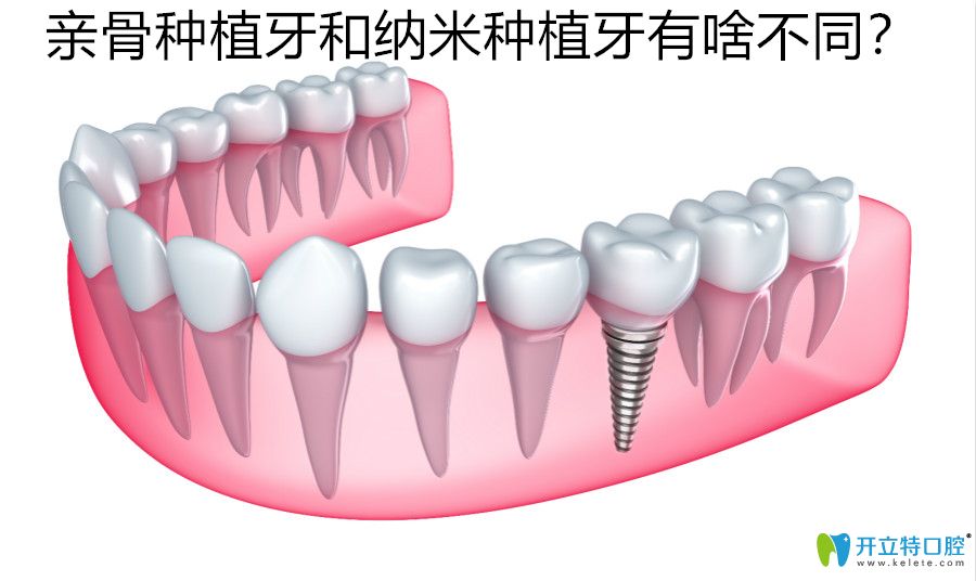 親骨種植牙和納米種植牙不同之處有啥