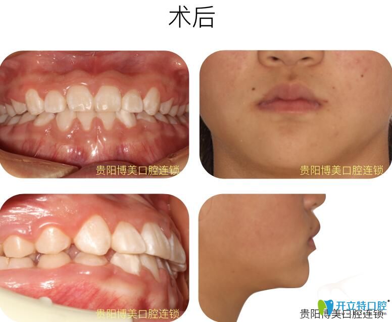 前牙反頜在<!--<i data=20240703-sp></i>-->口腔做牙齒矯正后照片