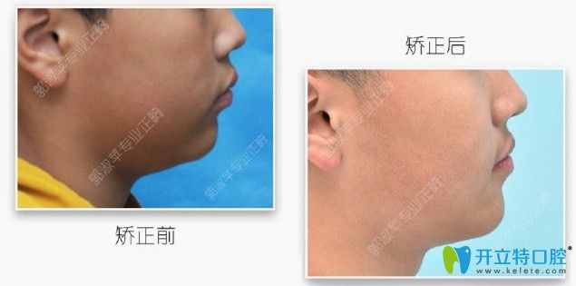 隱適美推磨牙向后臉型變化