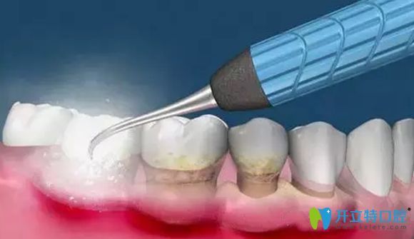 超聲波潔牙是預(yù)防和治療輕度牙周炎的方法