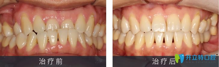 小姐姐個(gè)別門牙反頜經(jīng)美國3m自鎖托槽矯正后下巴終于歸位了