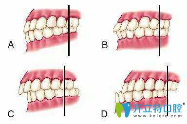 牙齒咬合不正 牙齒咬合不正