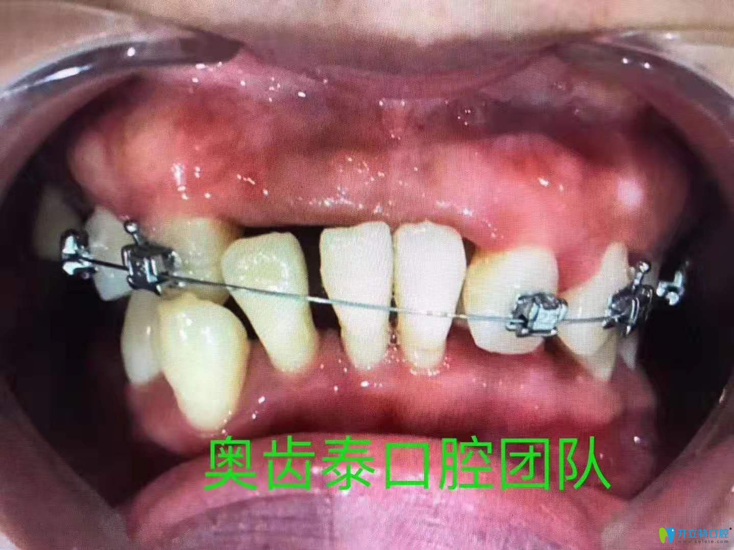 牙周炎都這樣了,金屬自鎖托槽矯正半年后這效果必須點贊