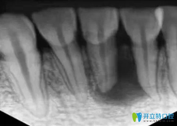 全新的根管治療步驟圖解出爐了