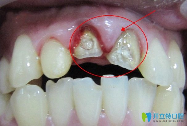 全瓷牙基牙發(fā)生根尖炎也會引起吃東西疼痛
