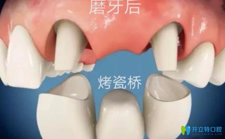 剛戴上全瓷牙咬東西疼是咋回事？趕緊戳進來看看吧