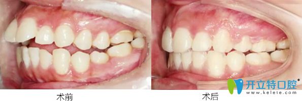 珠海愛思特口腔 齙牙矯正案例