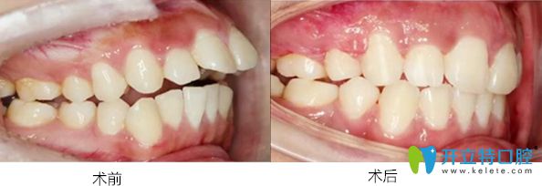 珠海愛思特口腔隱適美矯正案例