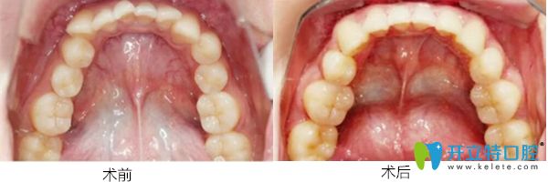 珠海愛思特口腔醫(yī)院開頜隱適美矯正