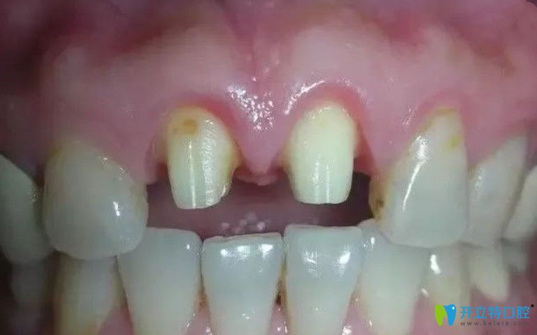 全瓷牙磨基牙后的圖