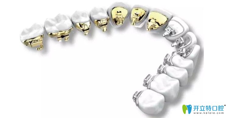 帶你走出長沙舌側(cè)隱形牙齒矯正價格的誤區(qū)