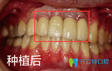 我在晉江修大夫口腔做韓國種植牙后效果