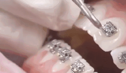 什么是傳統(tǒng)金屬托槽矯正