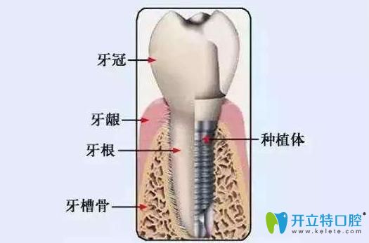 種牙熱點(diǎn)報(bào)道:種植牙和植骨手術(shù)可以同時(shí)進(jìn)行嗎?