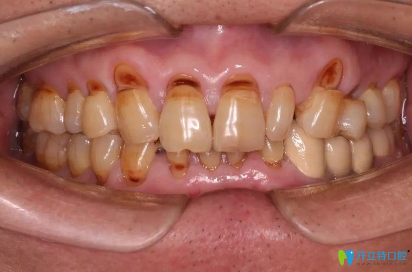 深圳這家牙科的醫(yī)生對牙楔狀缺損顧客做了什么竟被送錦旗