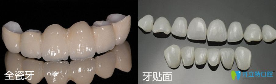 全瓷牙和牙貼面的區(qū)別