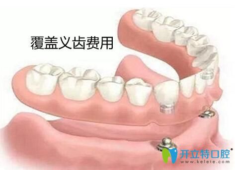 種植覆蓋義齒價(jià)格