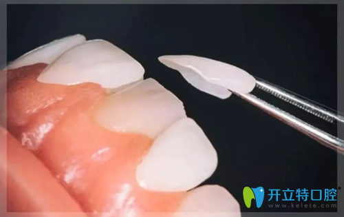 義烏傅氏口腔牙齒貼面