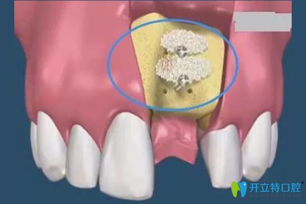 <!--<i data=20240703-sp></i>-->口腔任猛醫(yī)生科普做種植牙為啥要種骨粉