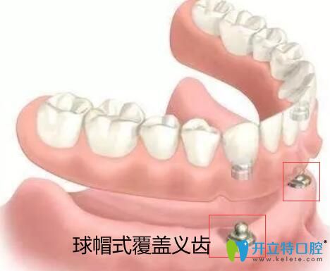 價(jià)格吊打種植牙的全口覆蓋義齒修復(fù)到底有哪些優(yōu)缺點(diǎn)？