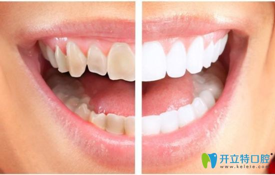 3D瓷貼面圖示 3D瓷貼面圖示