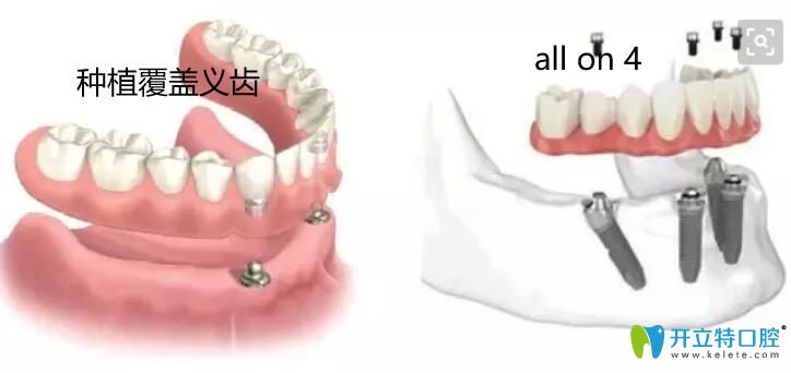 種植覆蓋義齒優(yōu)勢(shì)
