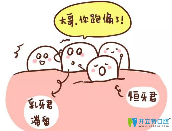乳牙滯留恒牙萌出會(huì)導(dǎo)致牙列不齊的情況出現(xiàn)