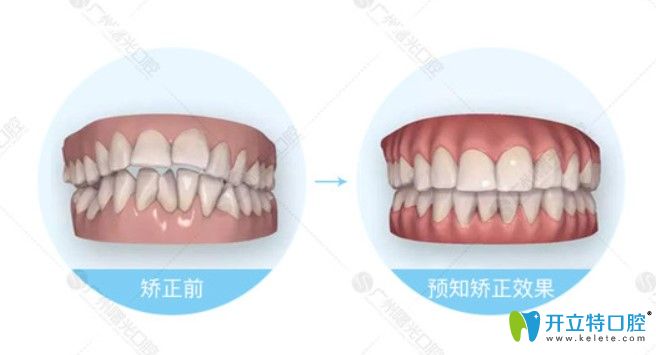 齙牙矯正前后3d效果圖