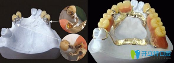 球形精密附著體