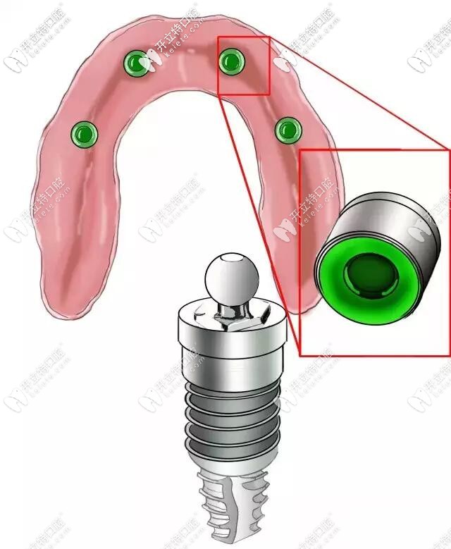 球帽基臺(tái)圖示