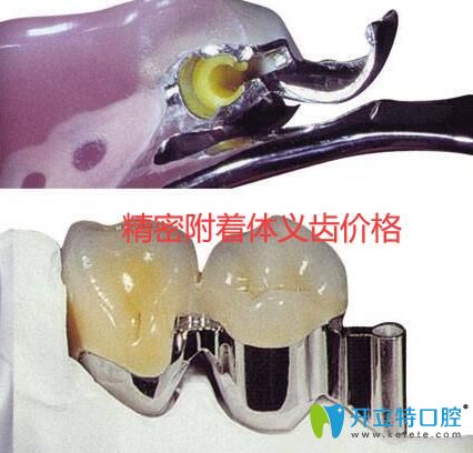 精密附著體義齒價格