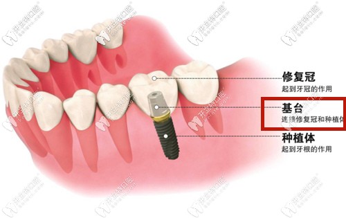 種植牙基臺(tái)部位