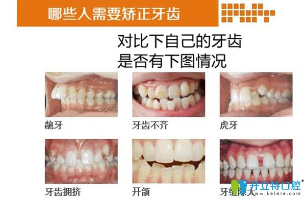 牙齒不齊的情況