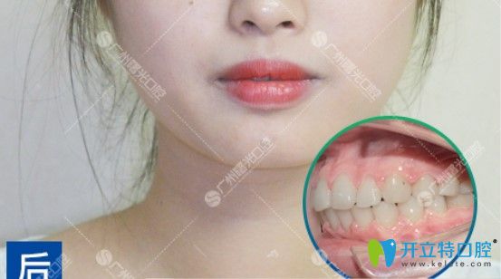 齙牙做完時(shí)代天使矯正后的樣子