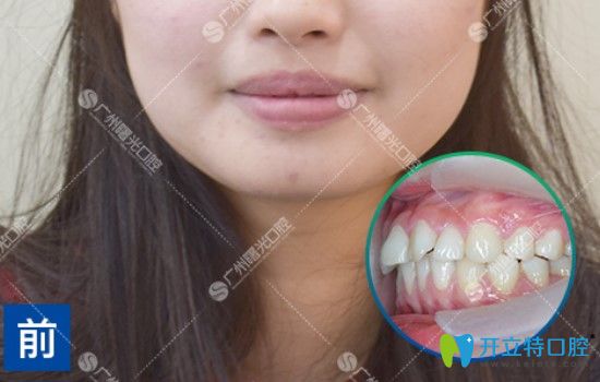 沒(méi)做矯正之前的牙齒情況