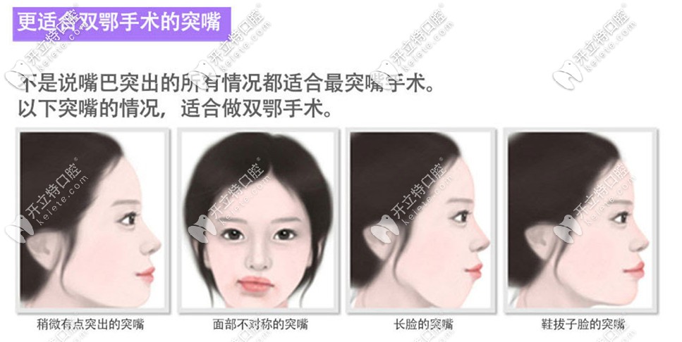 Faceline適合做雙鄂手術(shù)的凸嘴