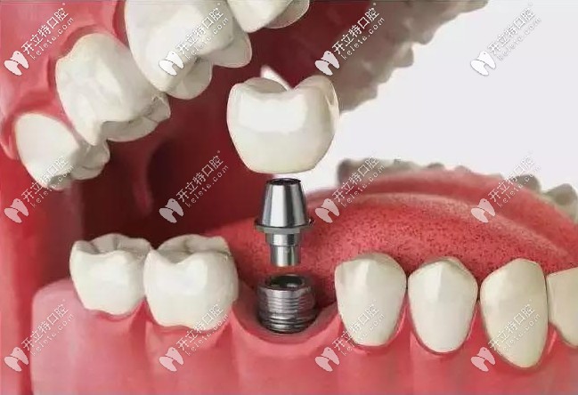 做種植牙的好處 做種植牙的好處