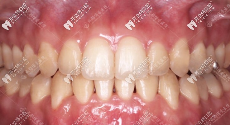 做完隱適美隱形矯正后的牙齒情況