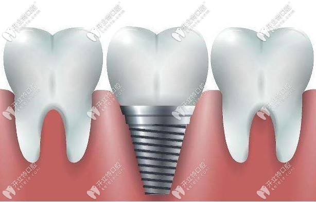 博愛種植牙活動時間及細(xì)則 博愛種植牙活動時間及細(xì)則